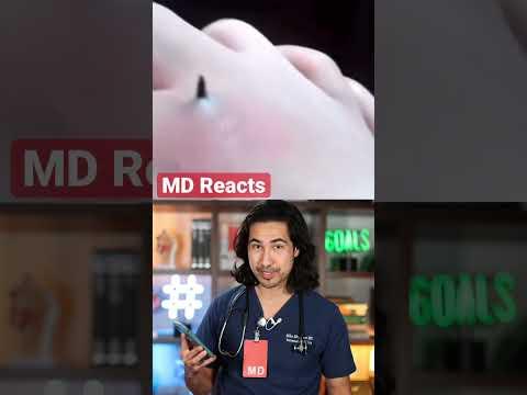 Wild Skin Tweezing! Doctor Reacts #skincare #ingrownhair #skin